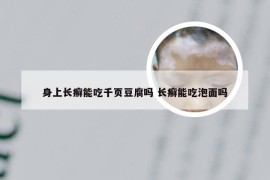 身上长癣能吃千页豆腐吗 长癣能吃泡面吗