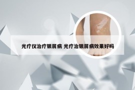 光疗仪治疗银屑病 光疗治银屑病效果好吗