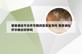 银屑病关节炎怀孕期间容易复发吗 银屑病在怀孕期会好转吗