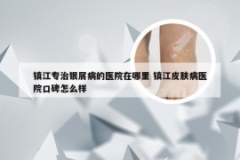 镇江专治银屑病的医院在哪里 镇江皮肤病医院口碑怎么样