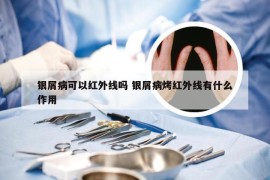 银屑病可以红外线吗 银屑病烤红外线有什么作用