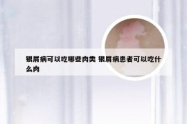 银屑病可以吃哪些肉类 银屑病患者可以吃什么肉