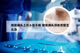 银屑病头上长小包不痒 银屑病头顶有疙瘩怎么治