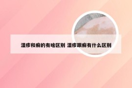 湿疹和癣的有啥区别 湿疹跟癣有什么区别