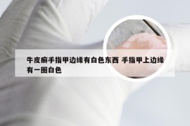 牛皮癣手指甲边缘有白色东西 手指甲上边缘有一圈白色