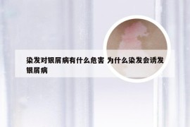 染发对银屑病有什么危害 为什么染发会诱发银屑病