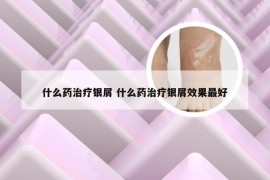 什么药治疗银屑 什么药治疗银屑效果最好