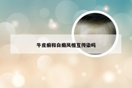 牛皮癣和白癜风相互传染吗