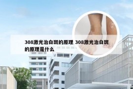 308激光治白斑的原理 308激光治白斑的原理是什么