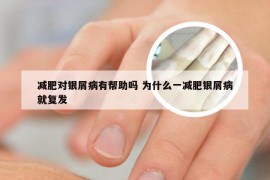 减肥对银屑病有帮助吗 为什么一减肥银屑病就复发