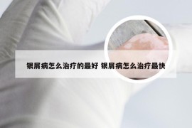 银屑病怎么治疗的最好 银屑病怎么治疗最快