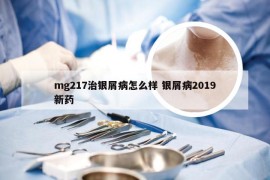 mg217治银屑病怎么样 银屑病2019新药