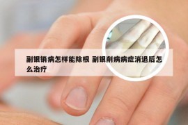 副银销病怎样能除根 副银削病病症消退后怎么治疗