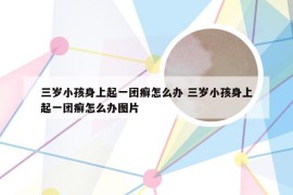 三岁小孩身上起一团癣怎么办 三岁小孩身上起一团癣怎么办图片