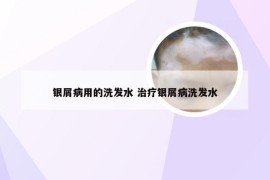 银屑病用的洗发水 治疗银屑病洗发水