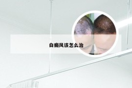 白癜风该怎么治