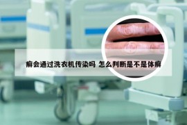 癣会通过洗衣机传染吗 怎么判断是不是体癣