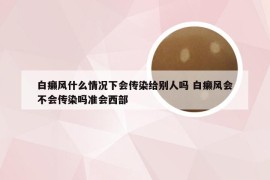 白癞风什么情况下会传染给别人吗 白癞风会不会传染吗准会西部