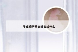 牛皮癣严重会转变成什么