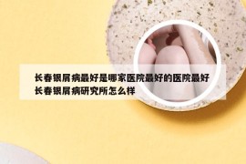 长春银屑病最好是哪家医院最好的医院最好 长春银屑病研究所怎么样