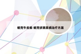 蛎壳牛皮癣 蛎壳状银屑病治疗方案