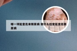 哪一项能查出来银屑病 做什么检查能查出银屑病