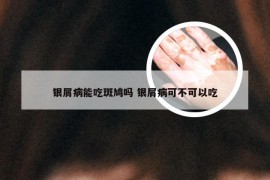 银屑病能吃斑鸠吗 银屑病可不可以吃