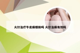 火针治疗牛皮癣根除吗 火针治癣有效吗