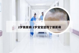 2岁银屑病 2岁宝宝遗传了银屑病