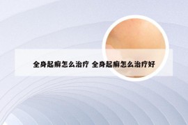 全身起癣怎么治疗 全身起癣怎么治疗好