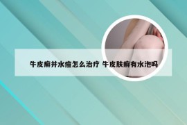 牛皮癣并水痘怎么治疗 牛皮肤癣有水泡吗