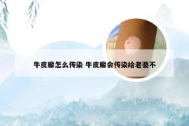 牛皮廨怎么传染 牛皮廨会传染给老婆不