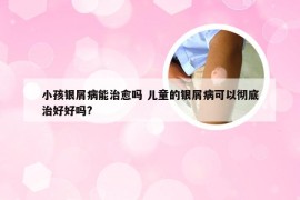 小孩银屑病能治愈吗 儿童的银屑病可以彻底治好好吗?