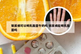 银屑病可以喝乳酸菌牛奶吗 银屑病能喝乳酸菌吗