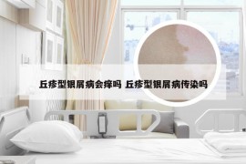 丘疹型银屑病会痒吗 丘疹型银屑病传染吗