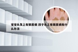 宝宝头发上有银屑病 孩子头上有银屑病有什么办法