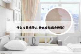 什么皮肤病传人 什么皮肤病会传染?