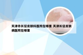 天津市长征皮肤科医院在哪里 天津长征皮肤病医院在哪里
