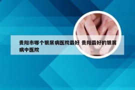 贵阳市哪个银屑病医院最好 贵阳最好的银屑病中医院