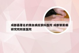 成都最著名的银血病皮肤科医院 成都银屑病研究院附属医院