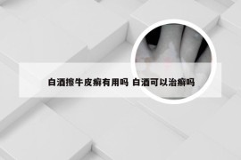 白酒擦牛皮癣有用吗 白酒可以治癣吗