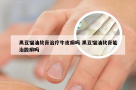 黑豆馏油软膏治疗牛皮癣吗 黑豆馏油软膏能治股癣吗