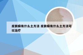 皮肤癣有什么土方法 皮肤癣有什么土方法可以治疗