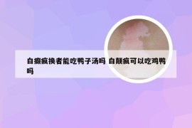 白癫疯换者能吃鸭子汤吗 白颠疯可以吃鸡鸭吗