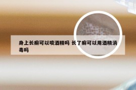 身上长癣可以喷酒精吗 长了癣可以用酒精消毒吗