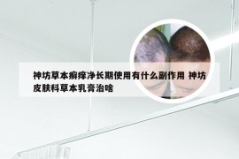 神坊草本癣痒净长期使用有什么副作用 神坊皮肤科草本乳膏治啥