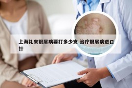 上海礼来银屑病要打多少支 治疗银屑病进口针