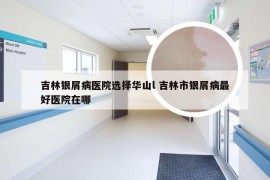 吉林银屑病医院选择华山l 吉林市银屑病最好医院在哪