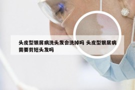 头皮型银屑病洗头发会洗掉吗 头皮型银屑病需要剪短头发吗