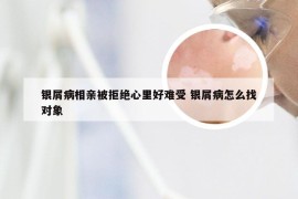 银屑病相亲被拒绝心里好难受 银屑病怎么找对象